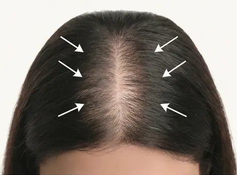 Hair loss in female