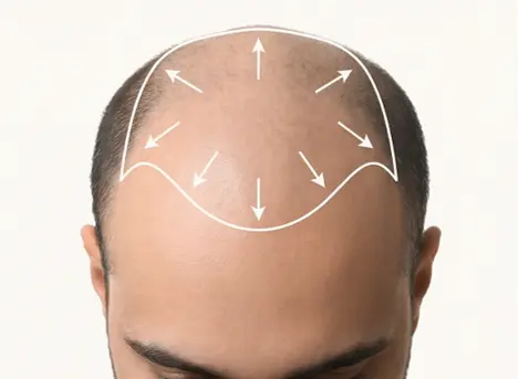 High grade severe baldness