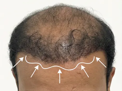 Repair hair transplant
