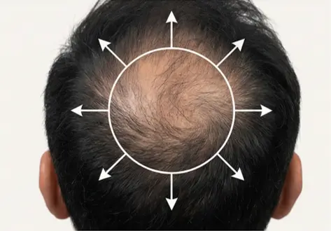 Thinning in crown area
